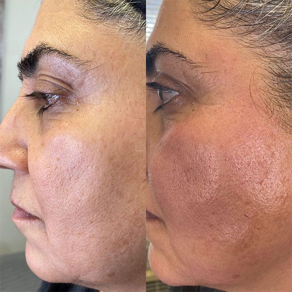 A woman with dark hair and blue eyes is shown before and after using the procedure. A woman with dark hair and blue eyes is shown before and after using the procedure.