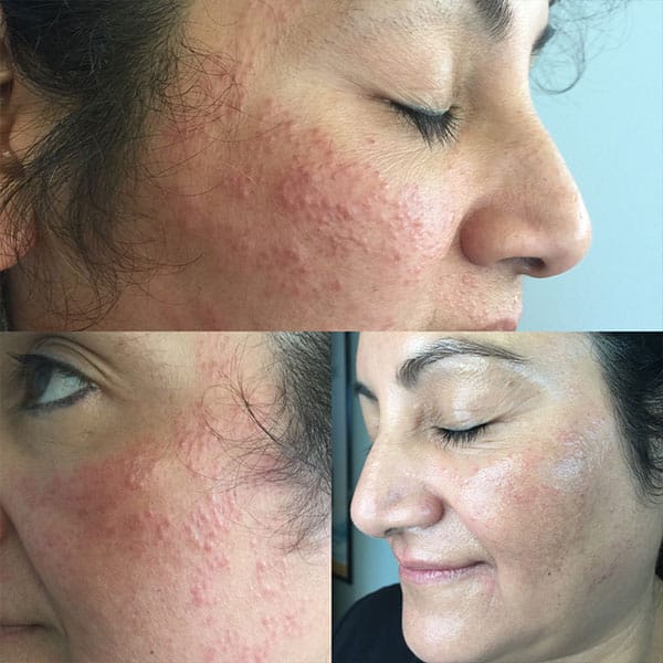 A woman with acne and redness on her face. A woman with acne and redness on her face.